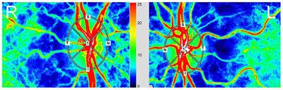 Ocular blood flow evaluation by laser speckle flowgraphy in pediatric patients with anisometropia